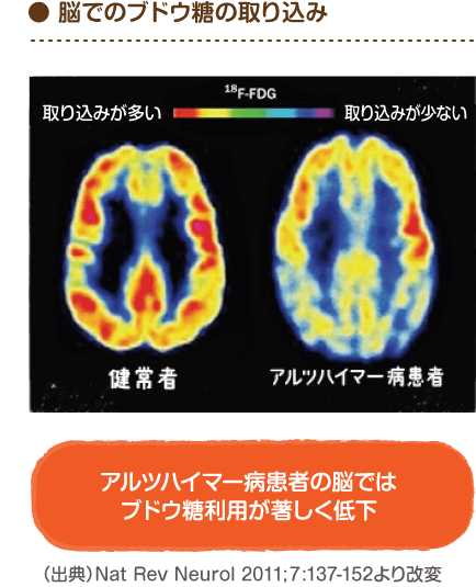 Mctサロン 脳の栄養不足を助ける Mct